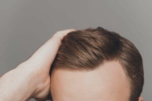 what causes balding